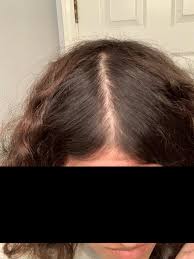 Can You Regrow Hair Loss From Pcos