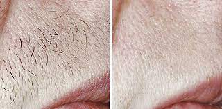 Upper lip hair is not only common with men but some women get it too. Laser Hair Removal For Women Who Have Polycystic Ovaries Good Skin Days