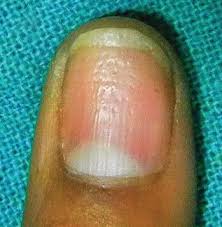 Maybe you would like to learn more about one of these? 8 Weird Things That Can Happen To Your Fingernails And What They Say About Your Health Women S Health
