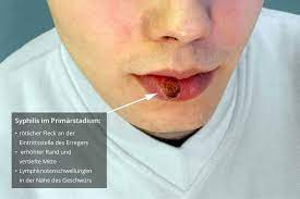 We did not find results for: Welche Symptome Treten Bei Syphilis Auf
