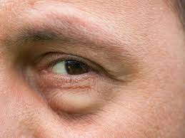 Geschwollene Augen Das Hilft Bei Dicken Augen