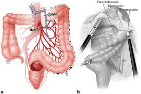 Colocolostomy | definition of colocolostomy by … colocolostomy: Pearls For The Small Bowel And Colon That Will Not Reach Abdominal Key