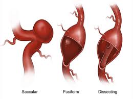 Aneurysms are bulging blood vessels in the body that can lead to rupture, leaking, and death. What Is A Brain Aneurysm Rwjbarnabas Health