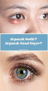 Arpacik Nedir Arpacik Nasil Gecer Iste Cevabi Dogal Cilt Bakimi Dogal Cilt Saglikli Yasam