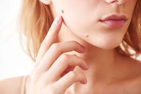 Webmd tells you what to expect if you choose to have it removed. Cosmetic Mole Removal Kansas City Dermatologists At Epiphany Dermatology
