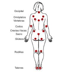 Zonas más comunes de las Úlceras Por Presión y su tratamiento - CMUC