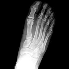 Lisfranc injury indicates disruption between. Lisfranc Injury Radiology Reference Article Radiopaedia Org