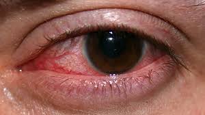 Check spelling or type a new query. Keratitis Types Pictures And Treatment