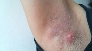 Tandis que la plupart des boutons forment un point noir ou blanc, les boutons sous cutanés forment une bosse rose et gonflée sous la peau. Comment Se Debarrasser Des Boutons Des Aisselles Des Zits Ou Des Boutons Comme Des Bosses Gesundmd