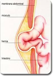 Pin By Adelaide Roark On Books Worth Reading Umbilical Hernia Hernia Repair Surgery