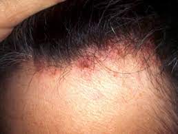 Diagnosis Of Scalp Rashes Dermnet Nz