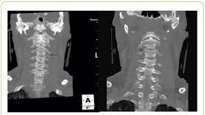 There is a strong association between transverse process fractures and other traumatic injuries. Ct Scan Of C Spine Sagittal View Showing Fracture Of Right Transverse Download Scientific Diagram