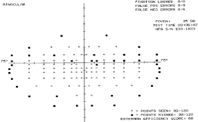 Example Of A Printout From The Binocular Esterman Visual