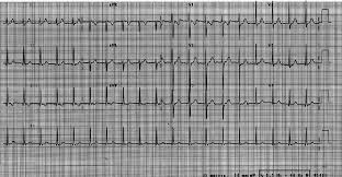 Accelerated junctional rhythm is when the rhythm of emerged impulses is more than 40 to 60 beats per minute, which is the natural range of the junction. Sustained Accelerated Junctional Rhythm Without Atrioventricular Download Scientific Diagram