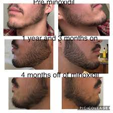 Using minoxidil speeds beard growth and development and allows faster results! After 1 Year And 3 Months Of Minoxidil Foam 5 I Stopped For Approximately 4 Months And Lost A Lot Of My Gains I M Trying Again For Another Year With A Derma