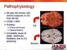 Late finding of co poisoning. Carbon Monoxide Poisoning Ppt Video Online Download