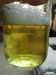 2) pengambilan protein secara berlebihan. Air Kencing Berbuih Seperti Air Sabun Tanda Awal Penyakit Buah Pinggang Cara Hidup Sihat