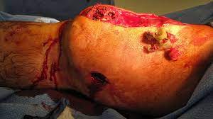Arrow vs human head ‍ navy seal jack carr. Gunshot Wounds 8 Real Life Cases On The Receiving End Of Gunfire Personal Defense World