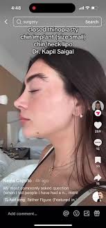 @Kayla Caputo #orlandofacialplastics #facialplasticspecialist #rhinoplasty  #closedrhinoplasty #chinimplant #liposuction #scarlessrhinoplasty  #transformation #naturalresults