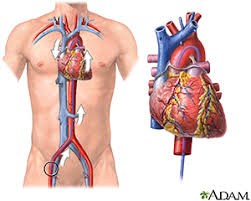 Angioplasty is often combined with the placement of a small wire mesh tube called a stent. Northside Heart Catheterization Angioplasty