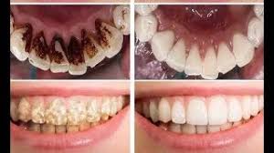 Maybe you would like to learn more about one of these? How Do You Remove Nicotine Stains From Dentures