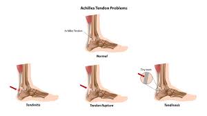 Podiatry Clinic Achilles Tendonitis Treatment