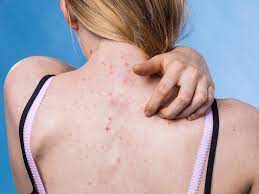 Can Acne Look Like A Rash Balmonds
