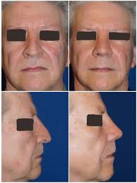 Rhinoplasty Surgery Center of Chattanooga