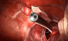 Polypectomy