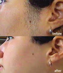 Laser hair removal, kingston is like no other laser hair removal clinic in london. Ipl Permanent Laser Hair Removal South London Light Fantastic Ipl Cinic