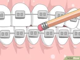 We did not find results for: How To Make Your Braces Hurt Less With Pictures Wikihow