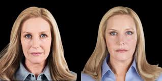 Face Contouring Dubai Abu Dhabi - Facial Sculpting In Dubai Offers Reviews  Best Aesthetic Clinic