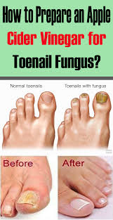 Nail fungus is one of the common types of fungal infection. How To Prepare An Apple Cider Vinegar For Toenail Fungus Foot Soak Page 2 Toenail Fungus Apple Cider Toe Nails