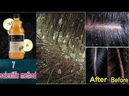 Let it get absorbed through the scalp and hair follicles, before rinsing. 7 Secret Way How To Remove Dandruff With Vinegar Natural Home Remedy Best Treatment Of Dandruff By Beautynovel1 Medium
