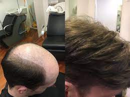 Protesi capelli parziale = base non oltre 10x10cm protesi capelli standard = base . Protesi Trapianto Capelli Milano Toupet Calvizia Friselli