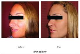 Pin On Rhinoplasty