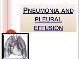 When you have a pleural effusion, fluid builds. Pneumonia And Pleural Effusion Definition Is An Acute