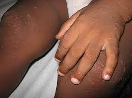 Les moms, pour le syndrome pied main bouche, il fait faire un détour chez le médecin pour avoir un traitement ou ça part tout seul? Syndrome Pieds Mains Bouche Wikiwand
