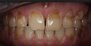 Tooth Enamel Erosion Causes Symptoms And Treatments