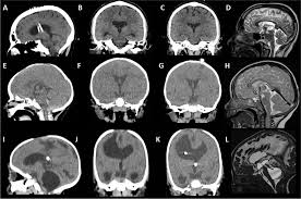 Neuroendoscopic access to the third ventricle in patients with narrow  foramen of monro without stenosis/obstruction: role of foraminoplasty