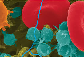 Myelofibrosis is an uncommon type of bone marrow cancer that disrupts your body's normal production of blood cells. What Is Bone Marrow Failure And How Is It Treated Dana Farber