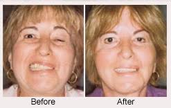 Bell's palsy affects men and woman equally. Facial Paralysis And Bell S Palsy Surgery Specialist Upper East Side New York Ny Elliott H Rose Md Plastic Surgeon The Aesthetic Surgery Center