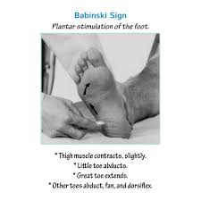 Image result for Babinski Reflex