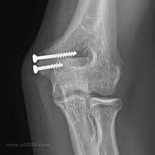 Related online courses on physioplus. Medial Epicondyle Fracture S42 442a 812 43 Eorif