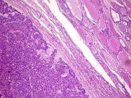 Pathology Outlines Follicular Adenoma