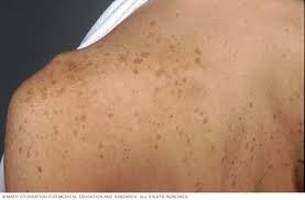 Image result for liver spots on legs