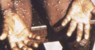 Check spelling or type a new query. Health Officials Issue Statement About Monkeypox Outbreak In North Wales Yorkshirelive