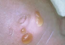 Image result for Impetigo