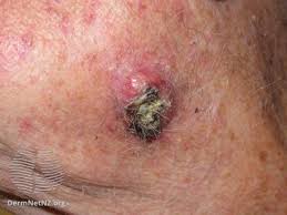 A hard lump under the skin does not necessarily indicate cancer. How To Tell A Lump From A Lymph Node