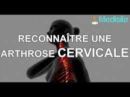 Die bewegungsfähigkeit des knies nimmt immer mehr ab 1. Reconnaitre Une Arthrose Cervicale Youtube